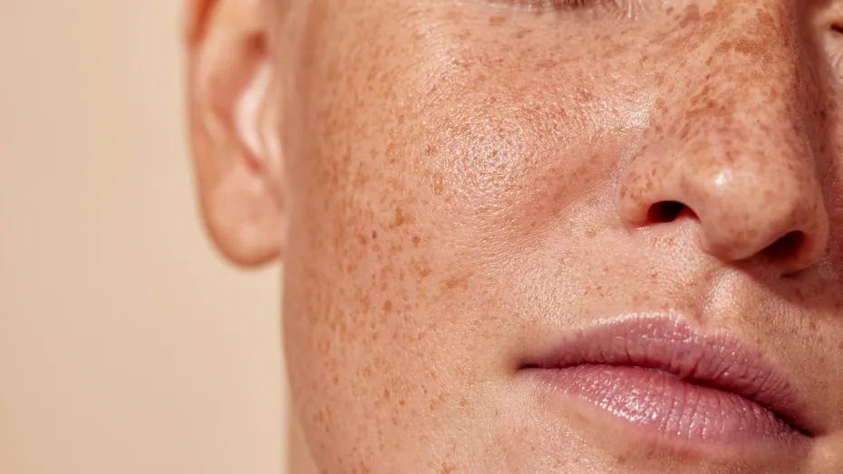 Petele întunecate de pe piele, semnale de alertă ale corpului. Cum te pot ajuta alimentația și antioxidanții să le estompezi