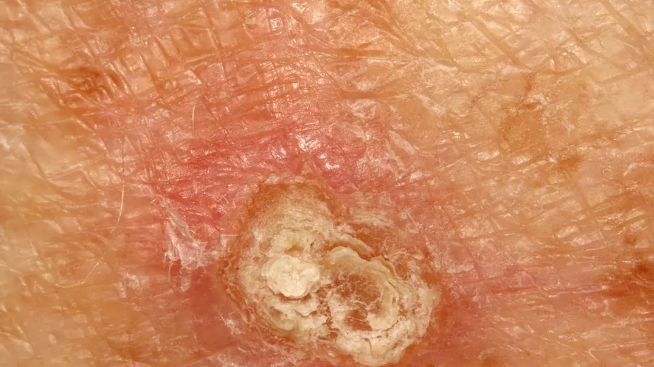 Carcinomul scuamos: cancerul de piele cu rată de vindecare 97%, dacă e depistat și tratat la timp