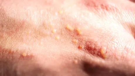 Alergia la soare – ce este, cum se manifestă, factori de risc şi măsuri de prevenţie