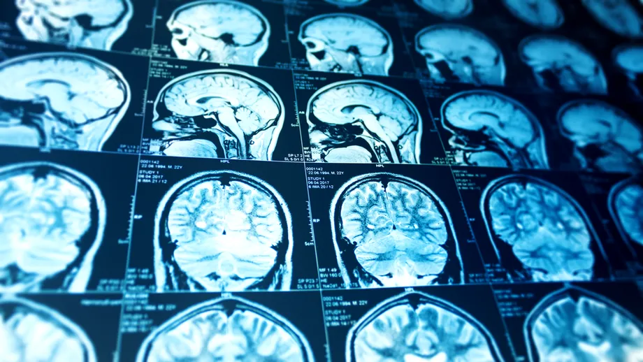 Este grupa de sânge legată de riscul de AVC înainte de 60 de ani? Ce spun studiile recente