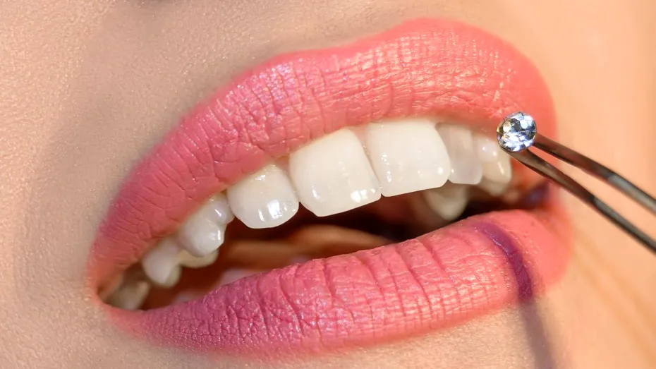 Bijuteriile dentare se aplică doar pe dintele natural! Ce durată de viață au aceste accesorii