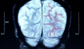 7 semne „tăcute” de alarmă care pot indica faptul că trebuie să faci angiografie cerebrală