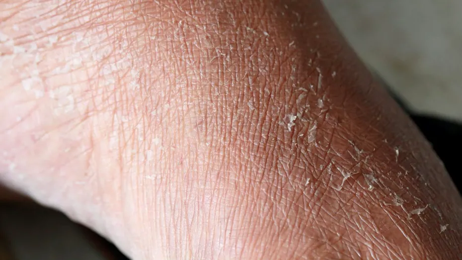 Ce semne apar pe piele dacă ai probleme cu tiroida sau glicemia