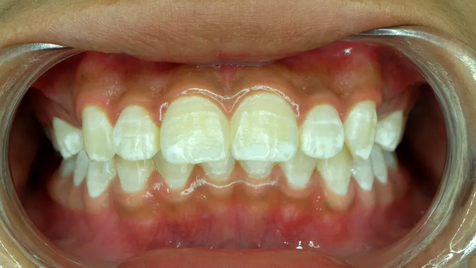 Fluorizarea dinților, cea mai bună metodă de a trata sensibilitatea dentară. În ce constă și în cât timp apar rezultatele