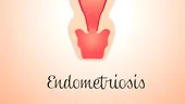 Ce este endometrioza? Diagnosticul si tratamentul endometriozei