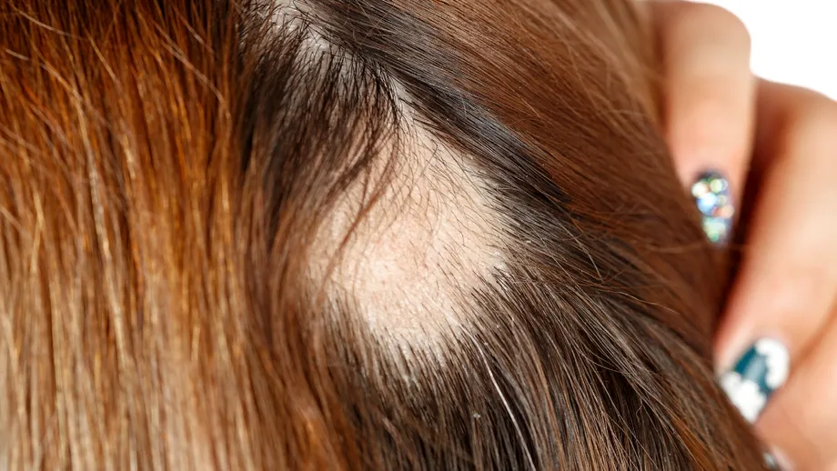 Băuturile din supermarket care te pot lăsa fără păr. Studiul care arată riscurile pentru podoaba capilară