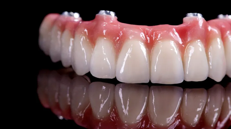 (P) Proteza fixă cu 6 implanturi: ghid complet despre etape, prețuri și beneficii