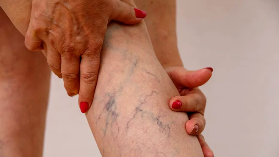Leacuri pentru venele sparte de sub piele. Nu „șterg” instant vasele sparte, dar scapi de roșeață și inflamație