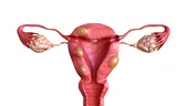 Fibrom uterin – 7 semne și simptome supărătoare