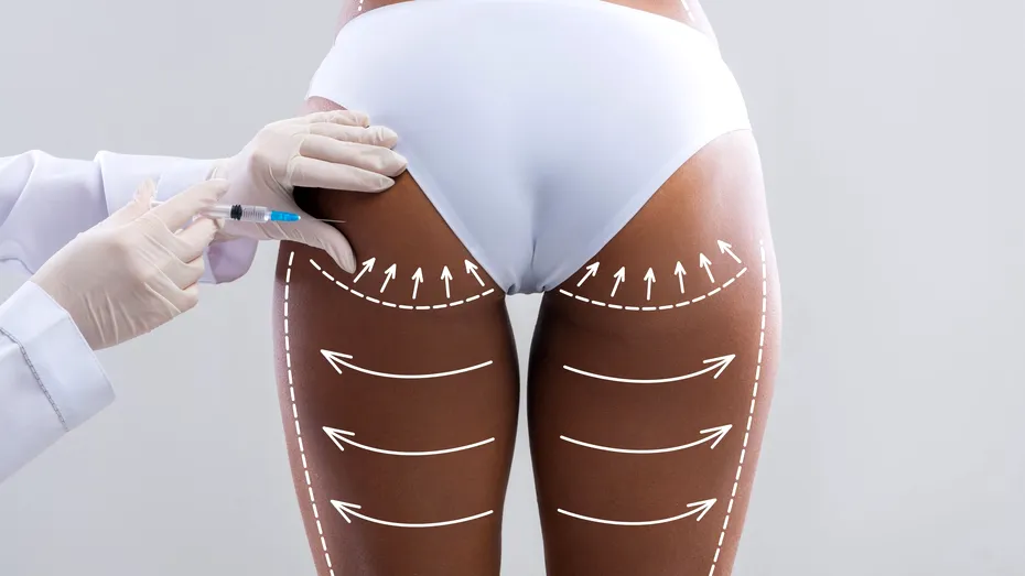 Un nou început în biostimularea injectabilă pentru corp | Dr. Anca Minca: 