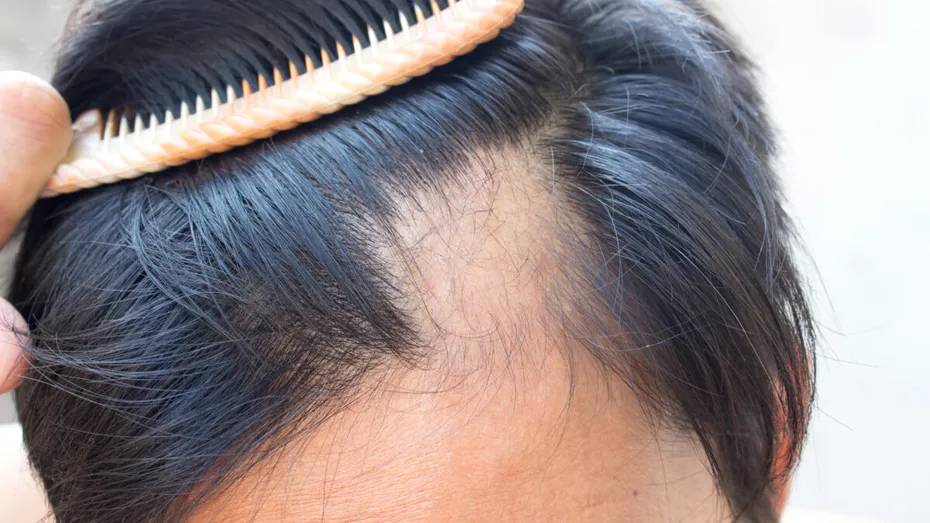 Părul tău merită mai mult: Dr. Diana Savu explică tot ce trebuie să știi despre alopecie și prevenție