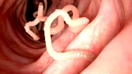 Teniaza: ce este, cauze, simptome, tratament, prevenţie