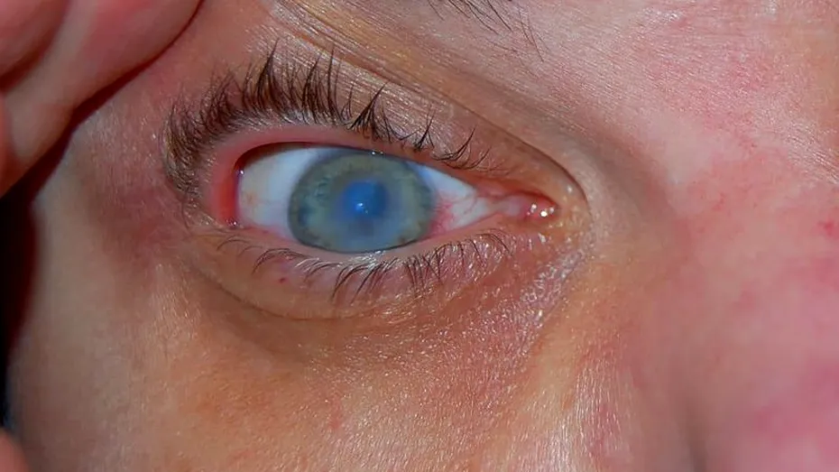 Cataracta, o boală a ochilor care afectează şi tinerii. Care sunt cauzele şi simptomele cataractei