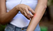 Țânțari purtători ai virusului West Nile au fost depistați în 4 sectoare din Capitală! Autoritățile sunt în alertă