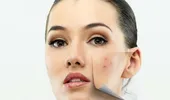 Tratamentul semnelor lăsate de acnee şi influenţa fructelor asupra aspectului pielii