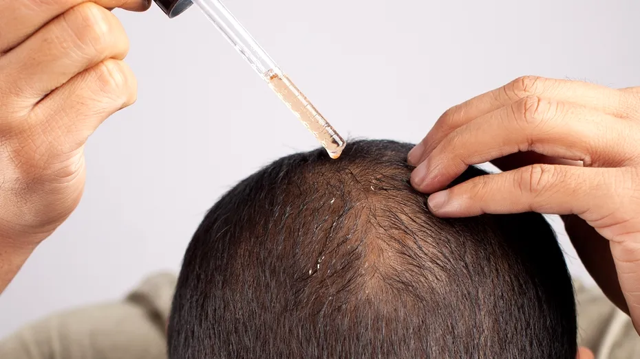 Minoxidil: beneficiile și riscurile utilizării tratamentului pentru regenerarea părului. Substanța, tot mai folosită și pentru sprâncene