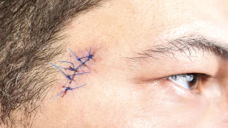 CEL MAI BUN tratament pentru cancerul de piele agresiv. Are 99% rată de VINDECARE!