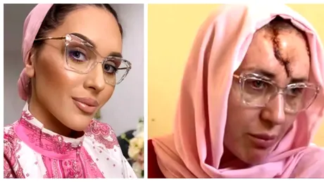 Cum arată acum Dana Roba la un an de când a fost desfigurată cu ciocanul. Se pregătește din nou de operație: „Nu am nici gust și nici miros”