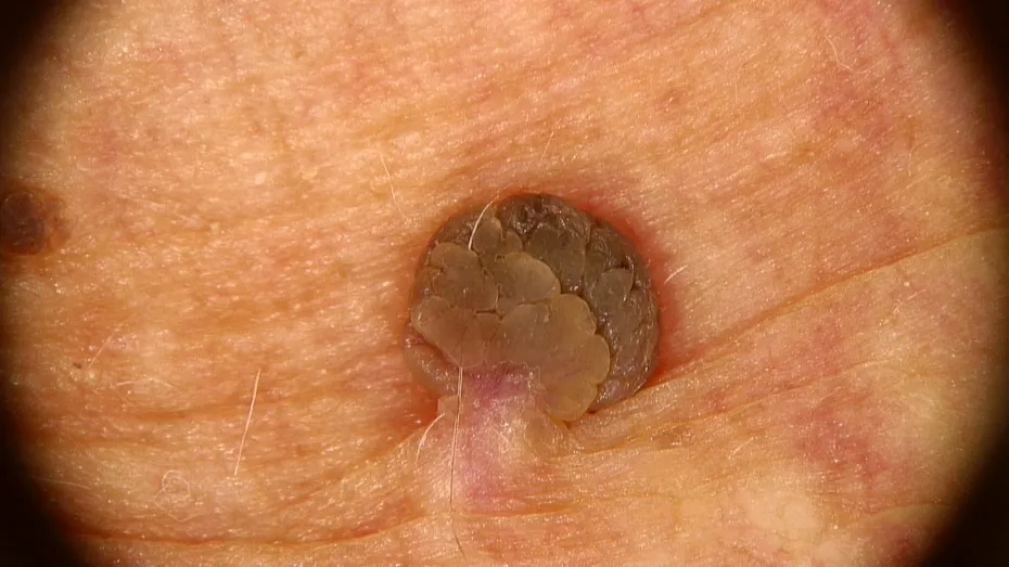 Cum poți scăpa definitiv de papiloame, gratis, cu trimitere. Dr. Michael Russu: „Cea mai simplă metodă este excizia, dar trebuie să prevenim și reapariția”