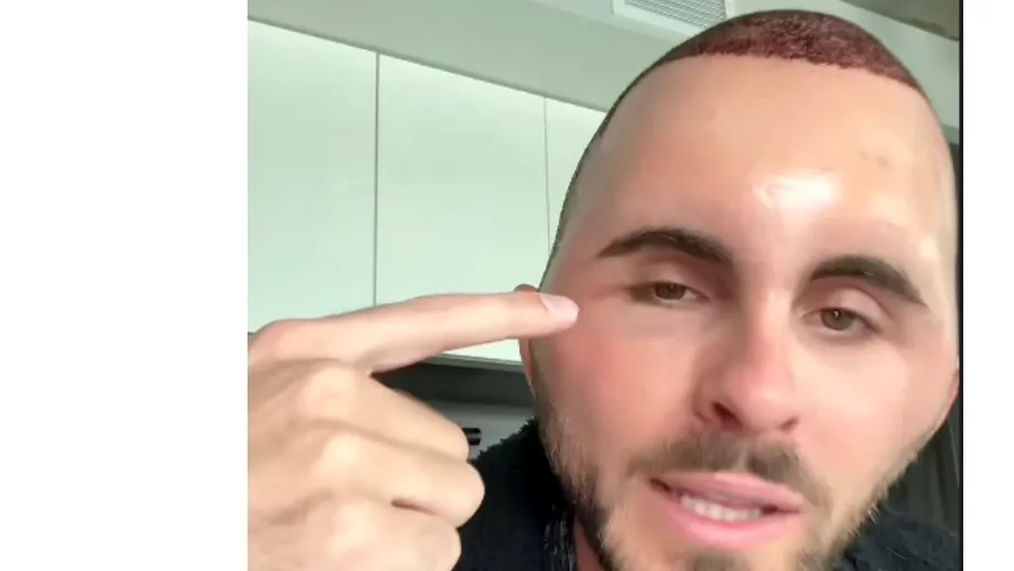 Transformare șocantă. Un transplant de păr de mii de dolari l-a făcut pe un tânăr de 27 de ani de nerecunoscut