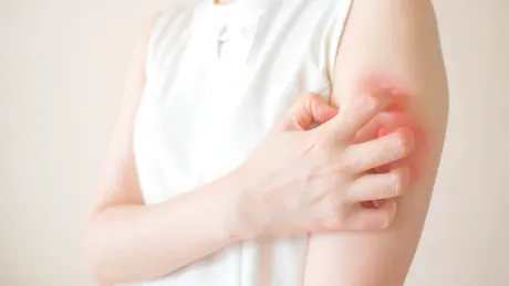 Urticaria: simptome si tratament