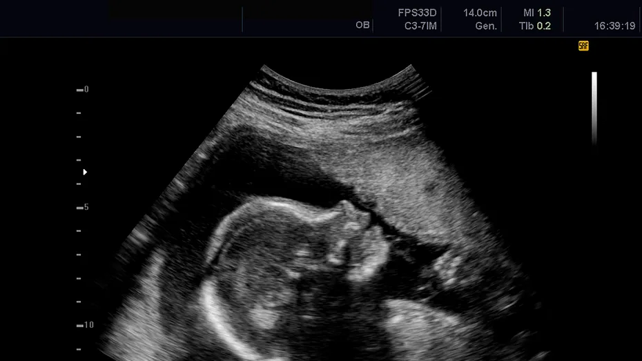 A stat mai bine de 56 de ani cu un făt pietrificat în pântece. Cum a trecut neobservat la analize