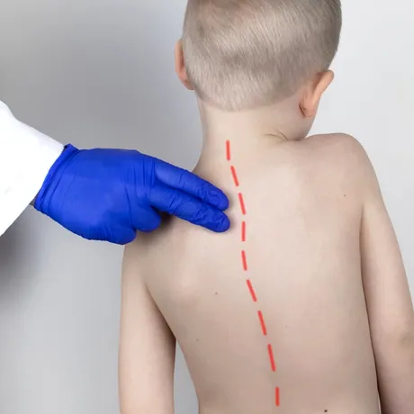 Cum putem identifica scolioza la copii. Primele semne ale afecțiunii