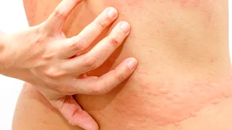 Urticarie solară: cauze, simptome, tratament