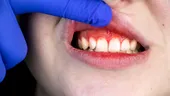 Gingii inflamate, sângerări? Iată ce trebuie să știi despre gingivită