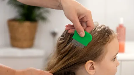 Remedii naturale pentru eliminarea păduchilor de cap: ce funcționează cu adevărat