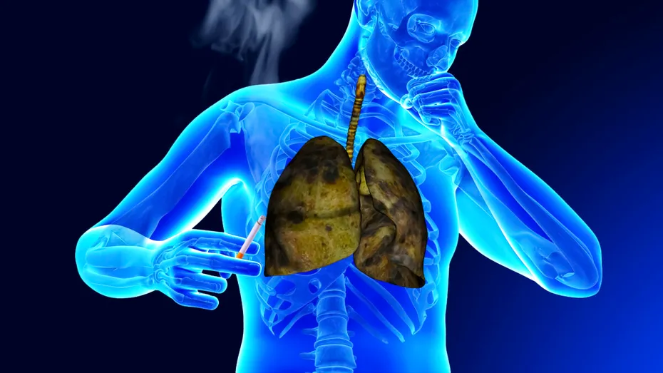 Primele semne de CANCER pulmonar. Unul se vede la analizele de sânge uzuale