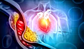 Poți face infarct chiar dacă ai colesterolul normal? Ce spun medicii despre riscul pe care analizele nu îl arată