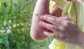 (P) Cum să ameliorezi mâncărimea şi inflamaţia după înţepăturile de insecte