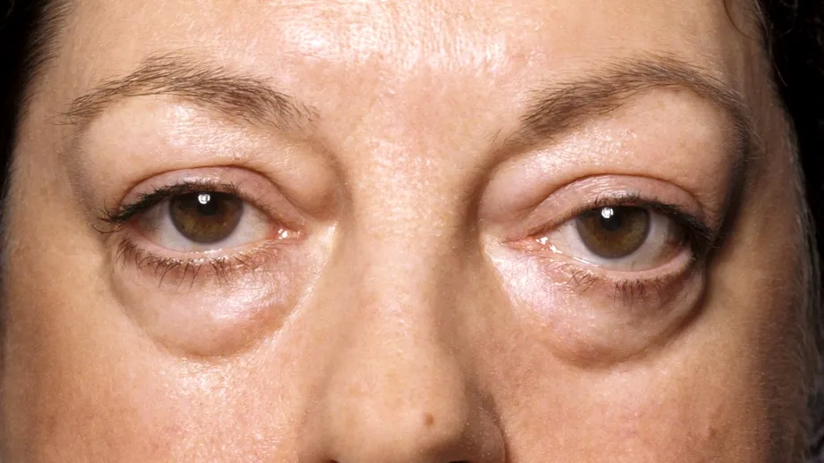 Semnul unei tiroide bolnave care se observă pe pleoape. Ce alte boli grave mai poți depista în funcție de aspectul ochilor