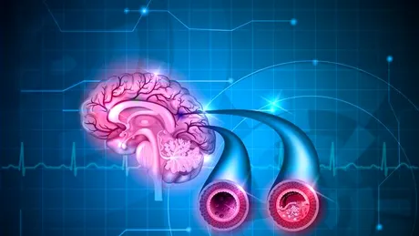 Dr. Bogdan Dorobăţ: simptome şi soluţii pentru accidentul vascular cerebral VIDEO by CSID