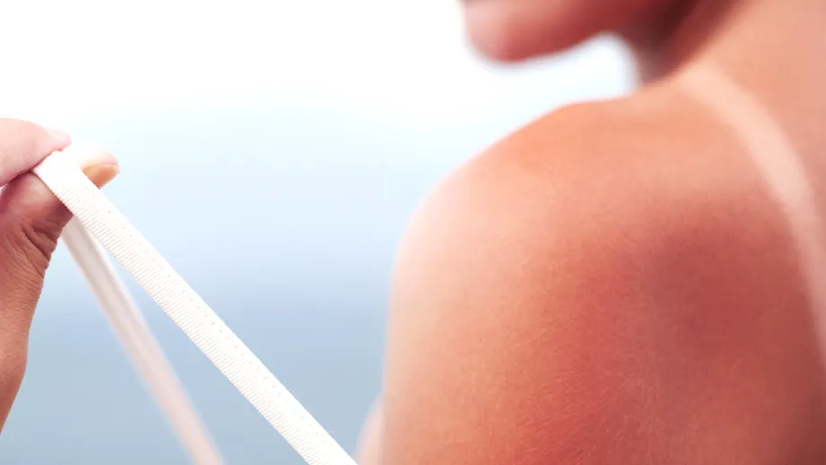 5 metode naturale prin care îți poți trata pielea după insolație