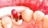 Scoaterea nervului dentar – de ce este indicată, chiar dacă nu te doare nimic?