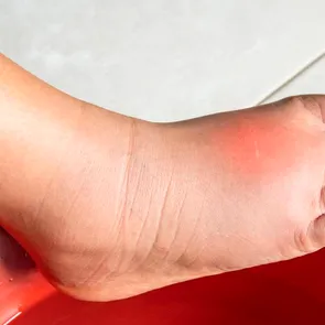 Ceaiul care tratează senzația de picioare grele