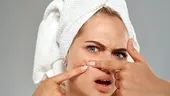Ai puncte albe pe față? Iată ce sunt și de ce NU trebuie să le storci