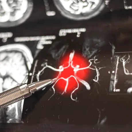 O moleculă din creier ar putea alimenta boala Alzheimer. Studiile au evidențiat un „comutator” al inflamației