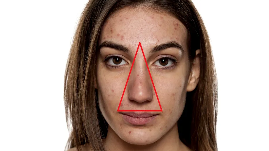 La ce pericol te expui dacă storci coșurile din „triunghiul morții”, o zonă foarte sensibilă de pe față