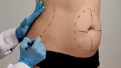 De ce „slăbirea” burții prin liposucție poate schimba proporțiile corpului