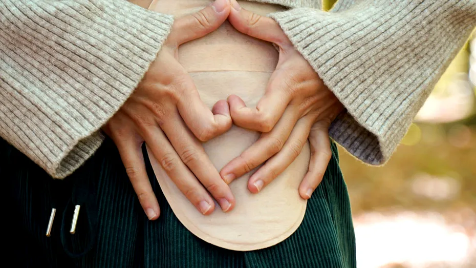 Operația care te scapă de anus contra naturii. Cum poți avea o viață normală, fără pungă stoma