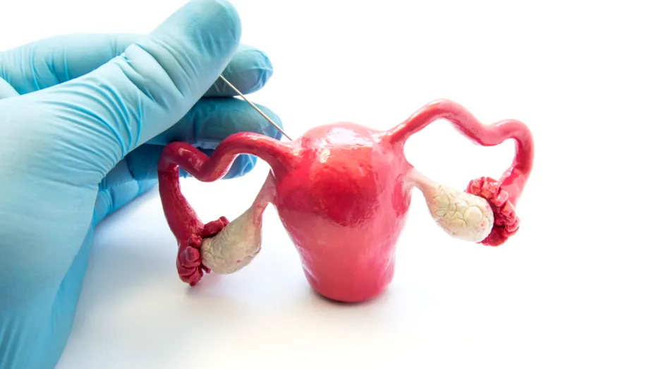 Când e necesară biopsia endometrială și ce implică aceasta? Ne spune dr. Andreas Vythoulkas