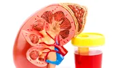 Urina cu sânge – ce afecțiuni ale rinichilor ascunde acest simptom