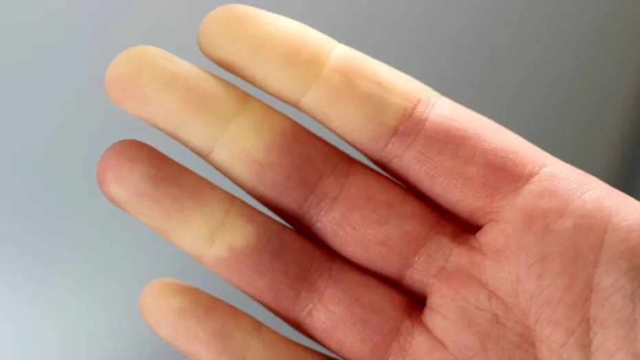 Probleme de sănătate cu care te poți confrunta dacă îți este permanent frig sau ai mâinile reci