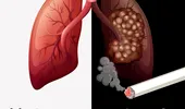 Medic pneumolog avertizează: modificările produse de fumat în plămâni sunt ireversibile