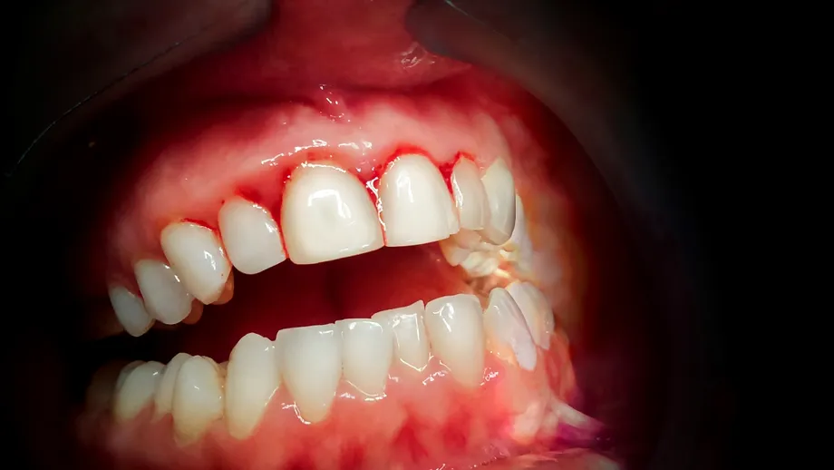 Gingiile sângerează frecvent? Iată ce boli pot fi de vină