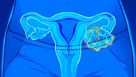 Cancerul ovarian atacă și fetele sub 18 ani! Factori de risc și primele semnale de alarmă