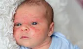 Dermatită atopică la nou născut – simptome (GALERIE FOTO)